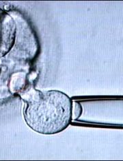 Man Sues Fertility Clinic Alleging it Stole His Sperm